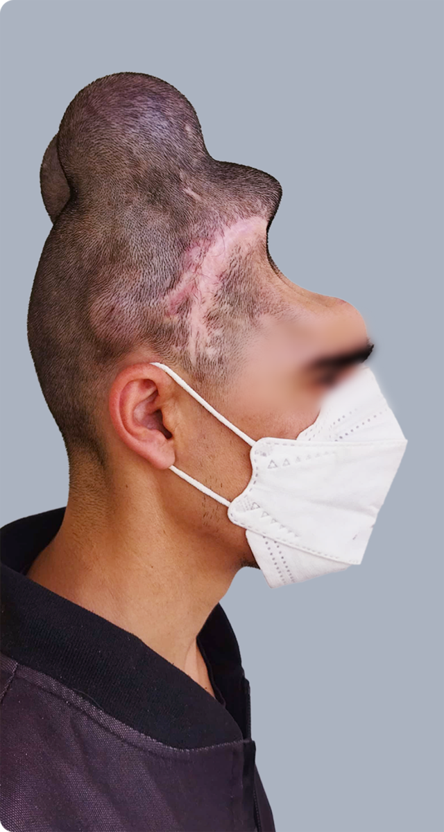Cranium PEEK implant case 01